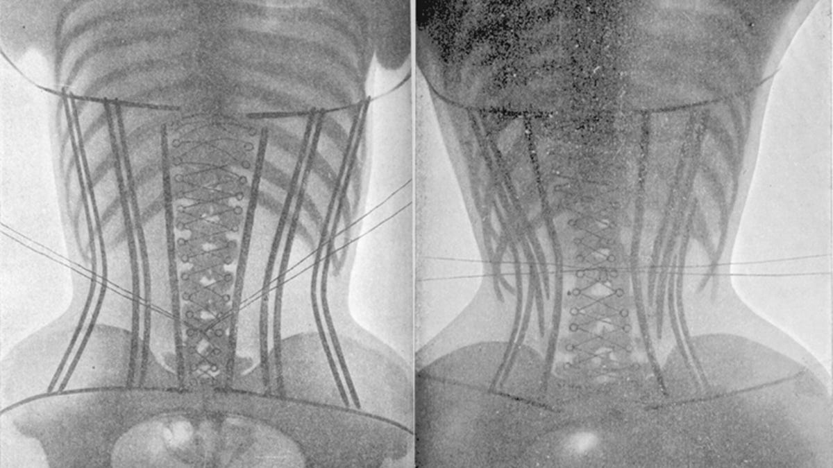 Vintage X Rays Reveal The Hidden Effects Of Corsets Cnet
