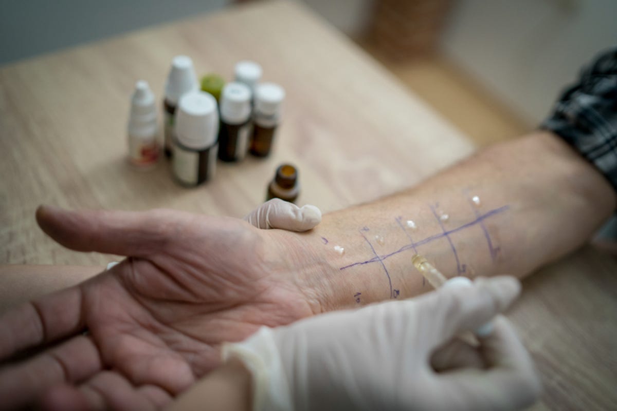 Doctor performing a skin prick allergy test on a patient.