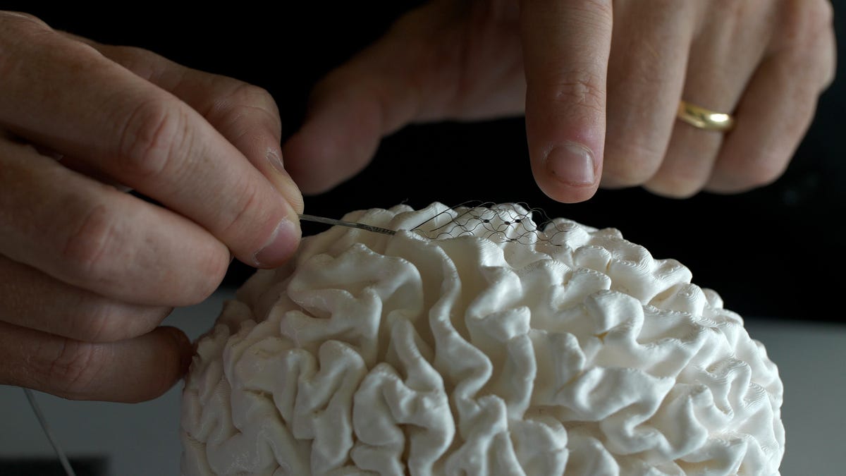 Hands approach a model of a brain to show where a Synchron implant would go