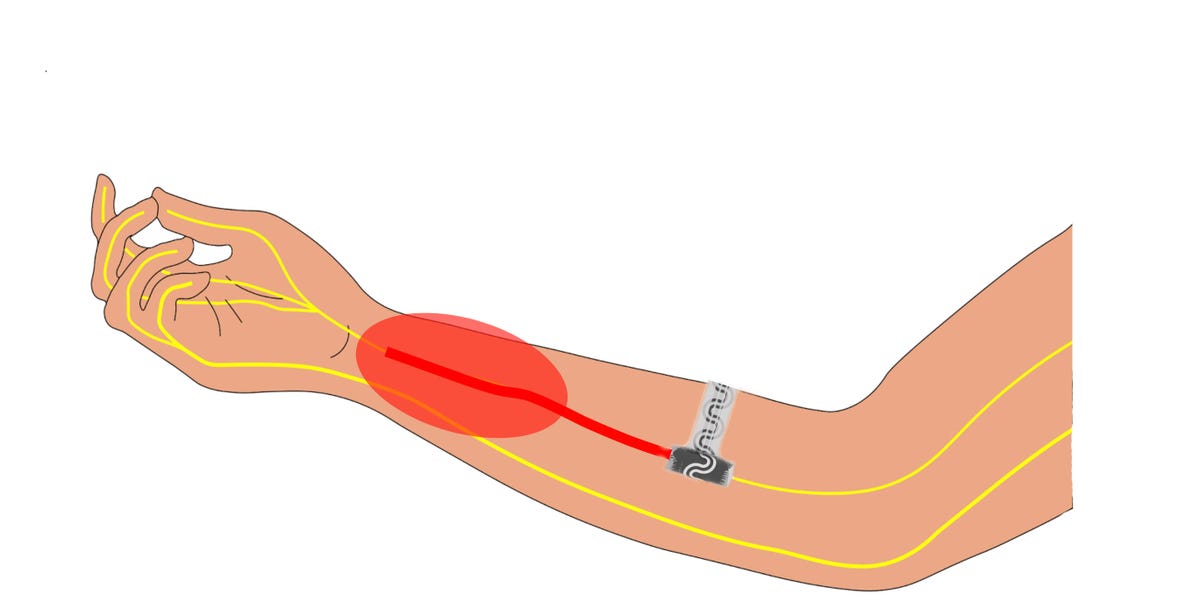 Diagram showing a forearm with the microfluidics device inserted near an area of ​​pain, indicated in red