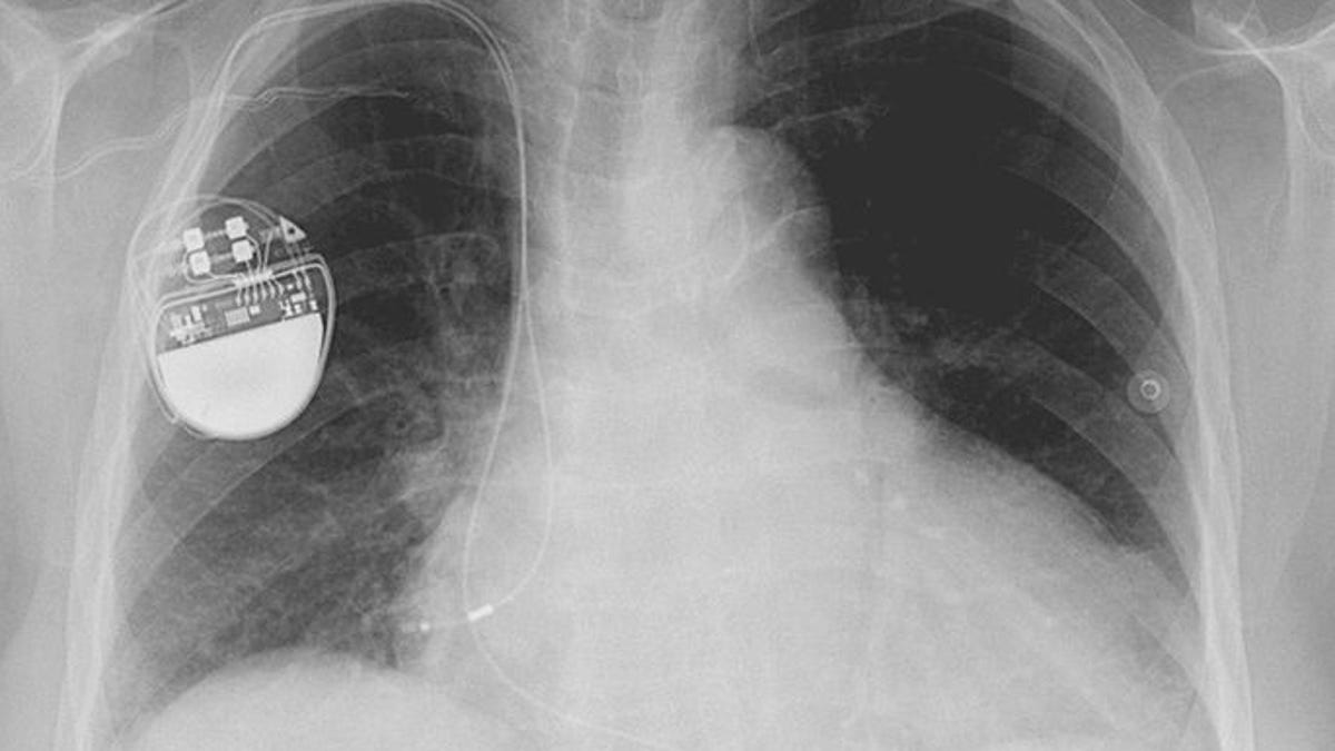 Pacemaker implanted