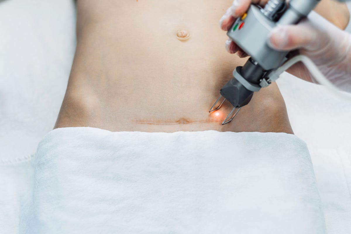 A person getting a scar on their abdomen treated with a laser