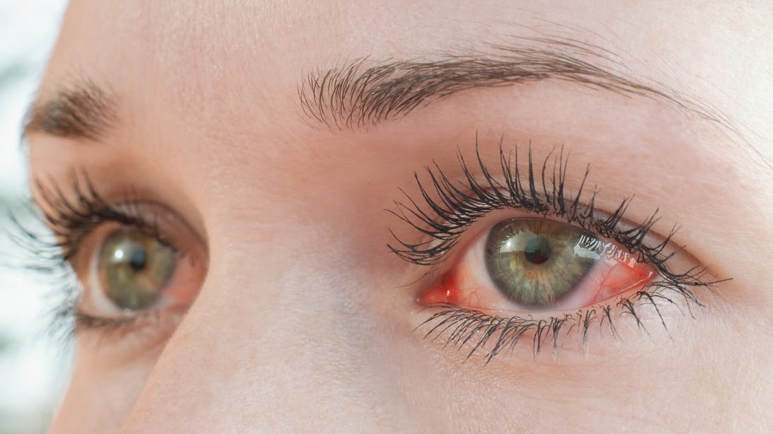 7 Home Remedies to Treat Dry, Itchy Eyes     – CNET