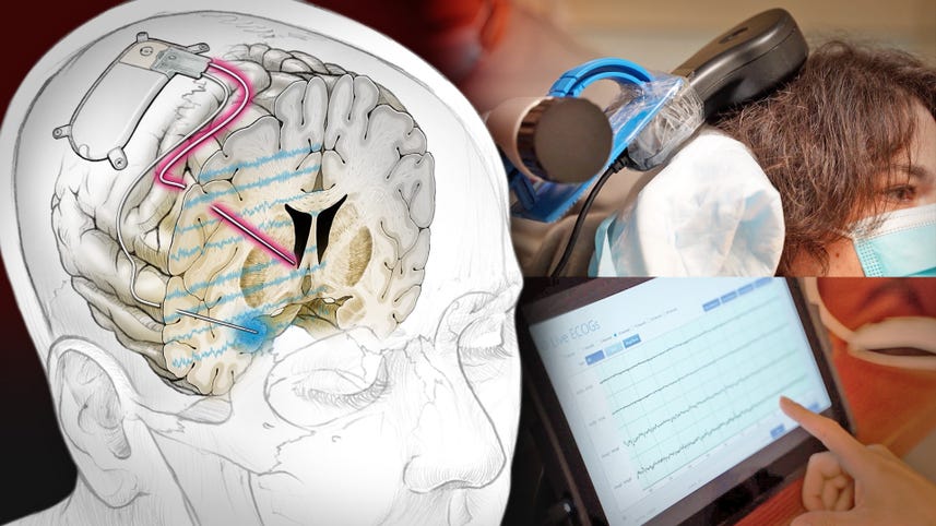 'Pacemaker for the brain': How a neural implant keeps a woman's depression at bay