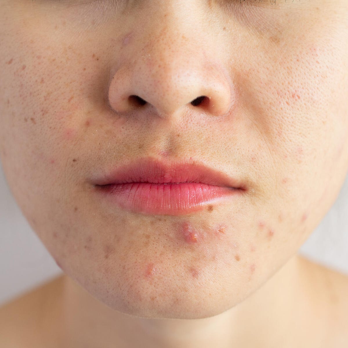 What is the #1 way to get rid of acne?