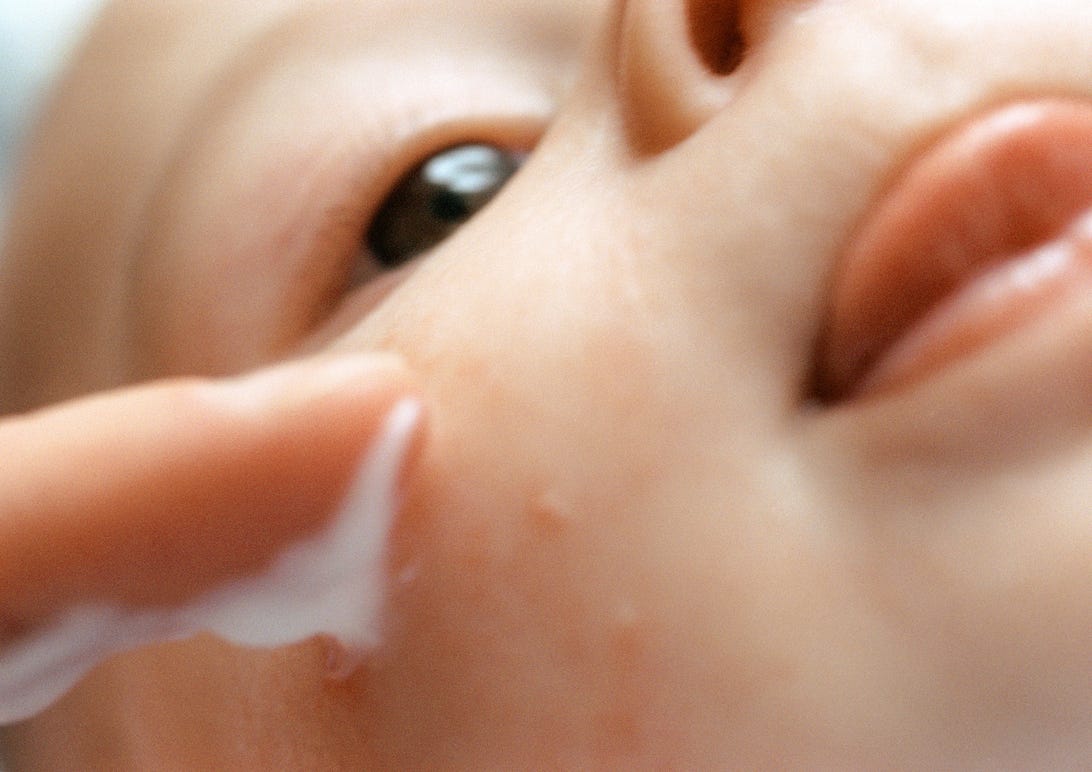 Close up of a baby's face with baby acne and an adult finger putting cream on affected area