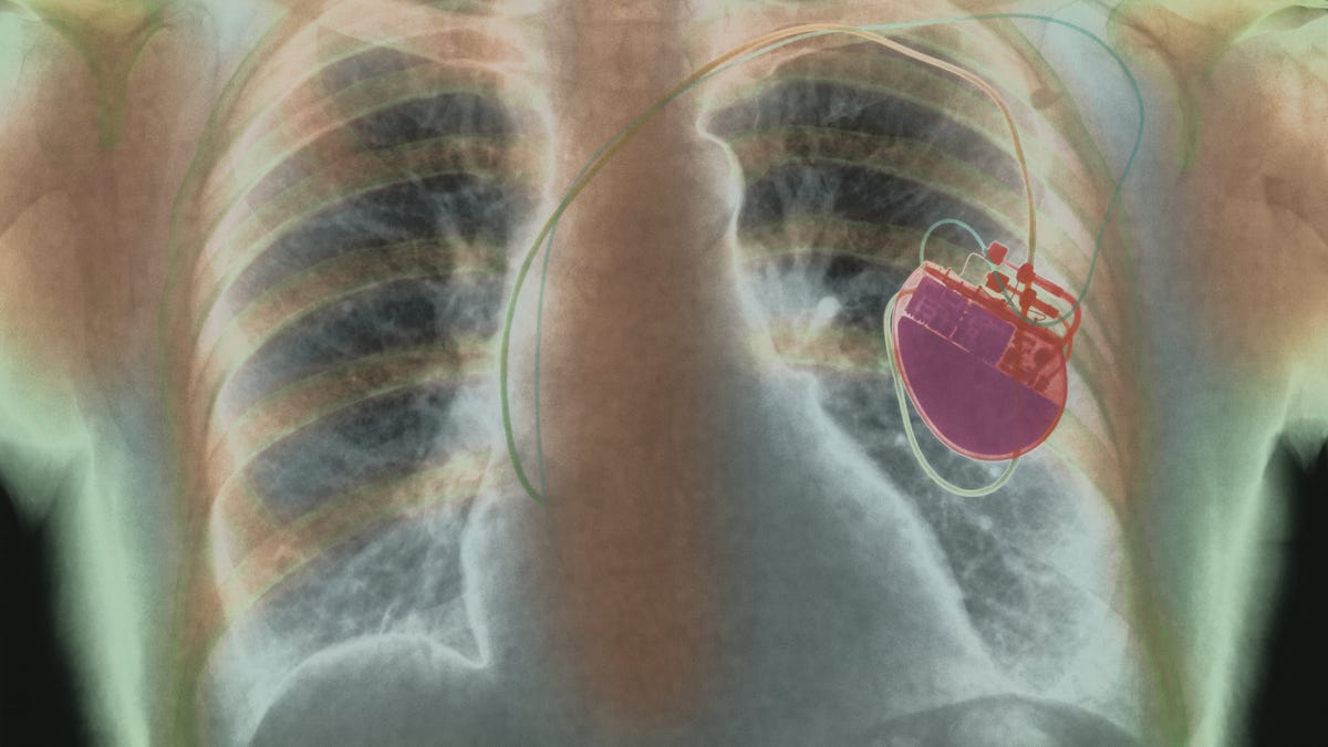 artificial-pacemaker.jpg