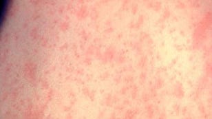 Measles in the US: What to Know About Outbreaks, Vaccines and More