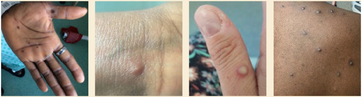 4 examples of monkeypox lesions