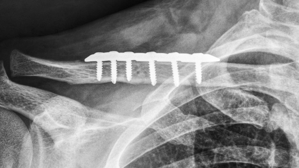 Doctors repaired my collarbone with the stainless steel plate shown in this X-ray image.
