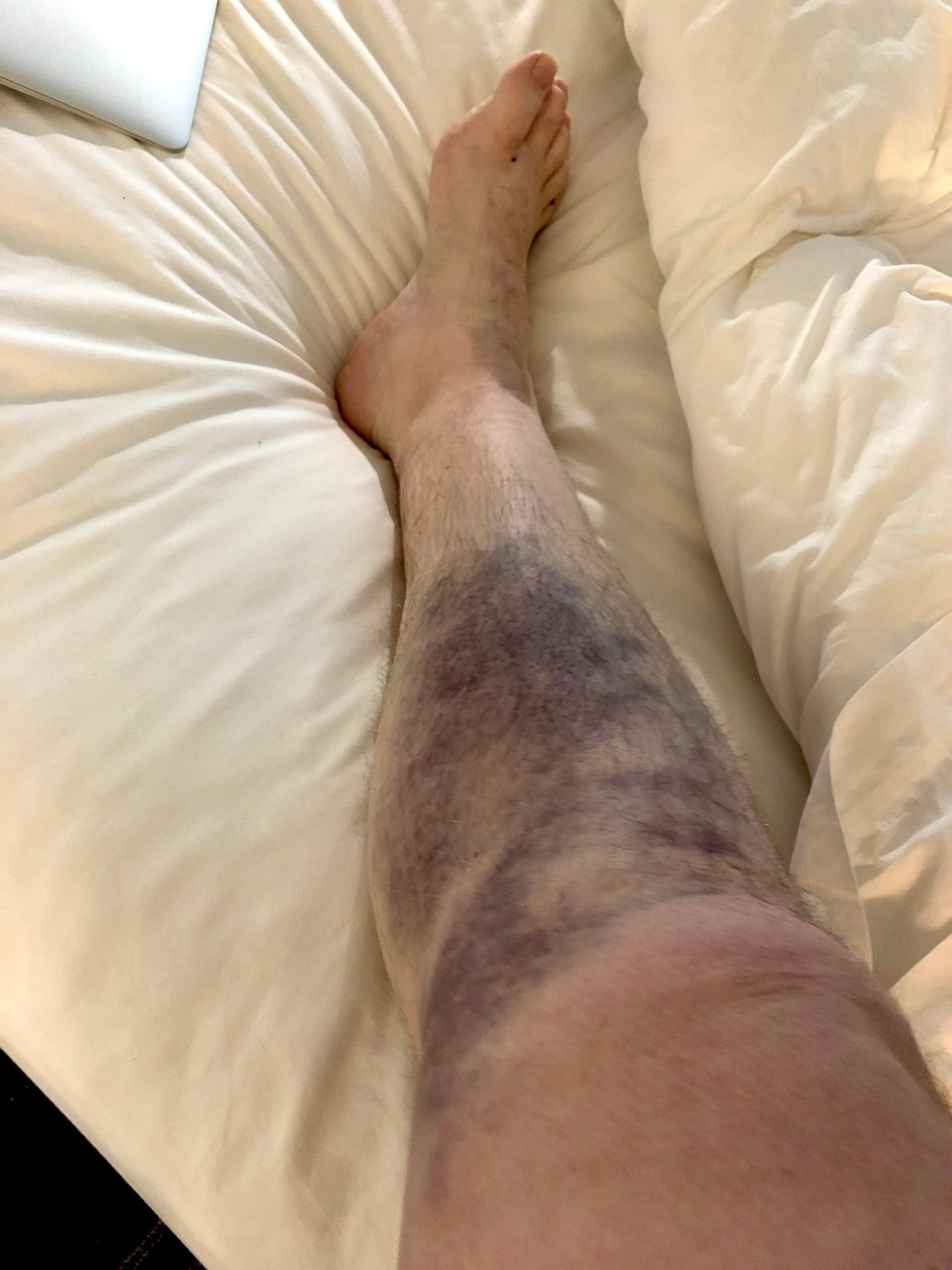 ultra-bruise
