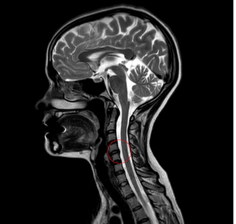 An MRI profile image of a person's spine, brain and skull