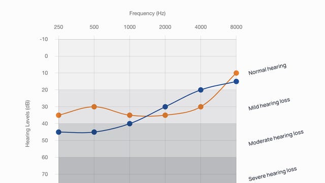 A sample of Soundly's results saying you have moderate hearing loss, with an audiogram.
