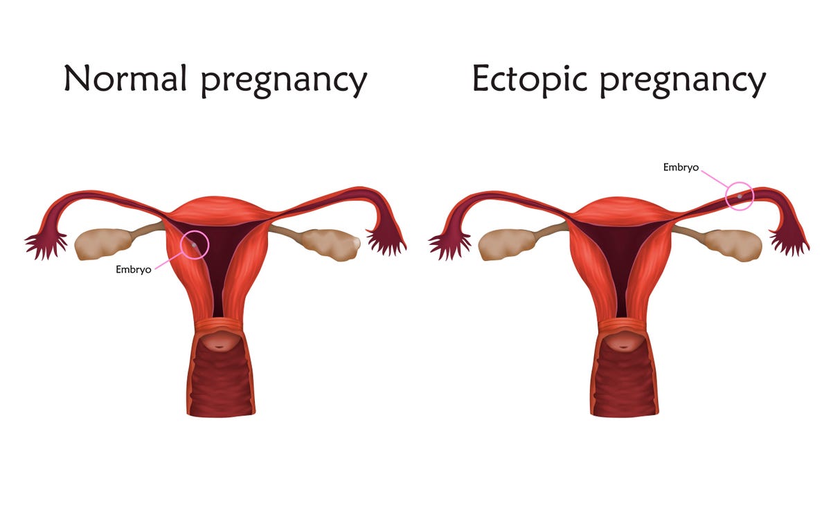 An illustration of a normal pregnancy versus an ectopic pregnancy