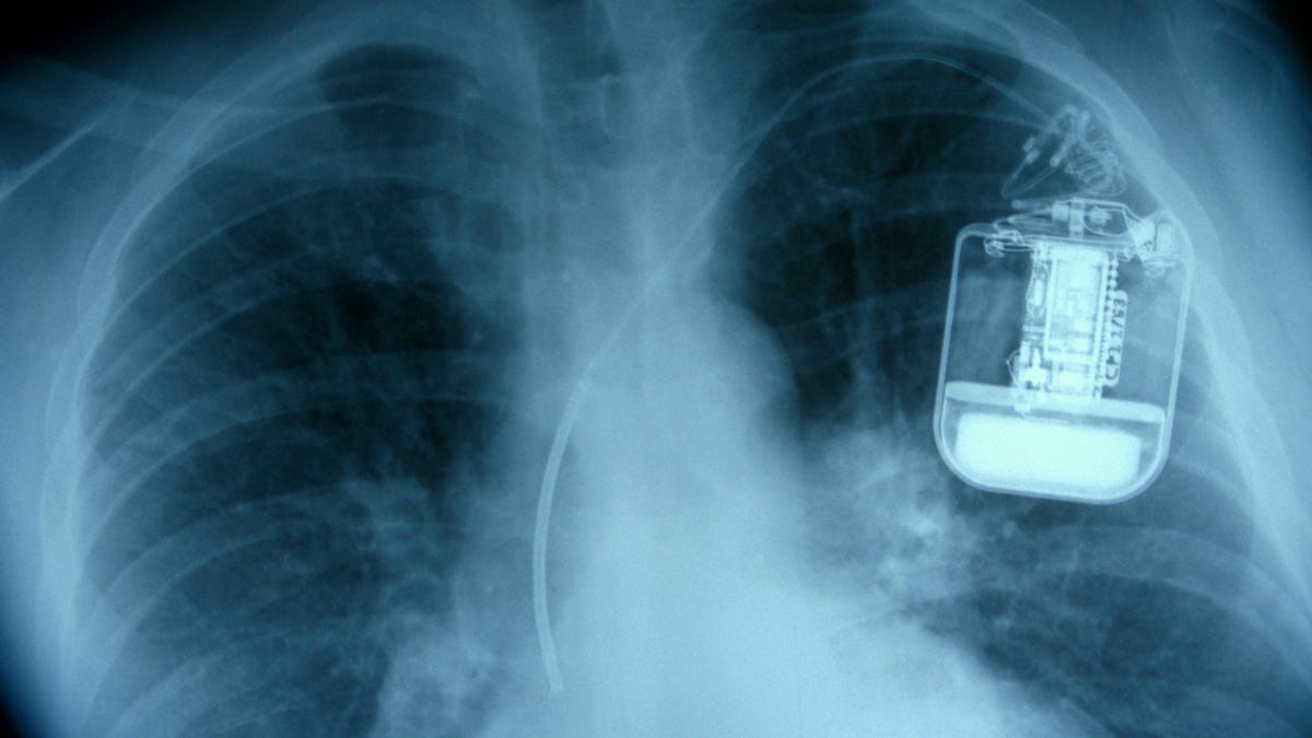 Lung X-Ray showing Pacemaker