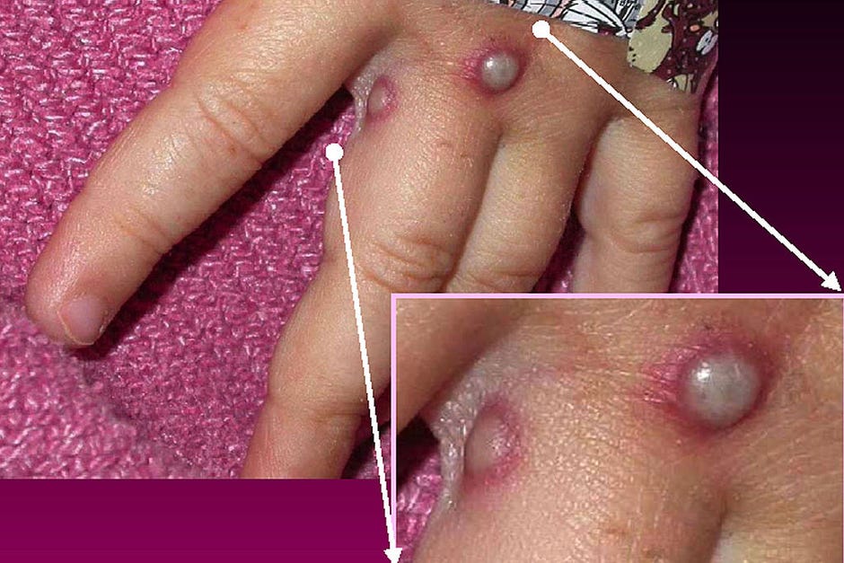 Pus filled monkeypox lesions on a hand
