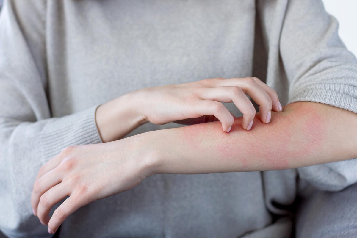 Person scratching their skin from allergic reaction.