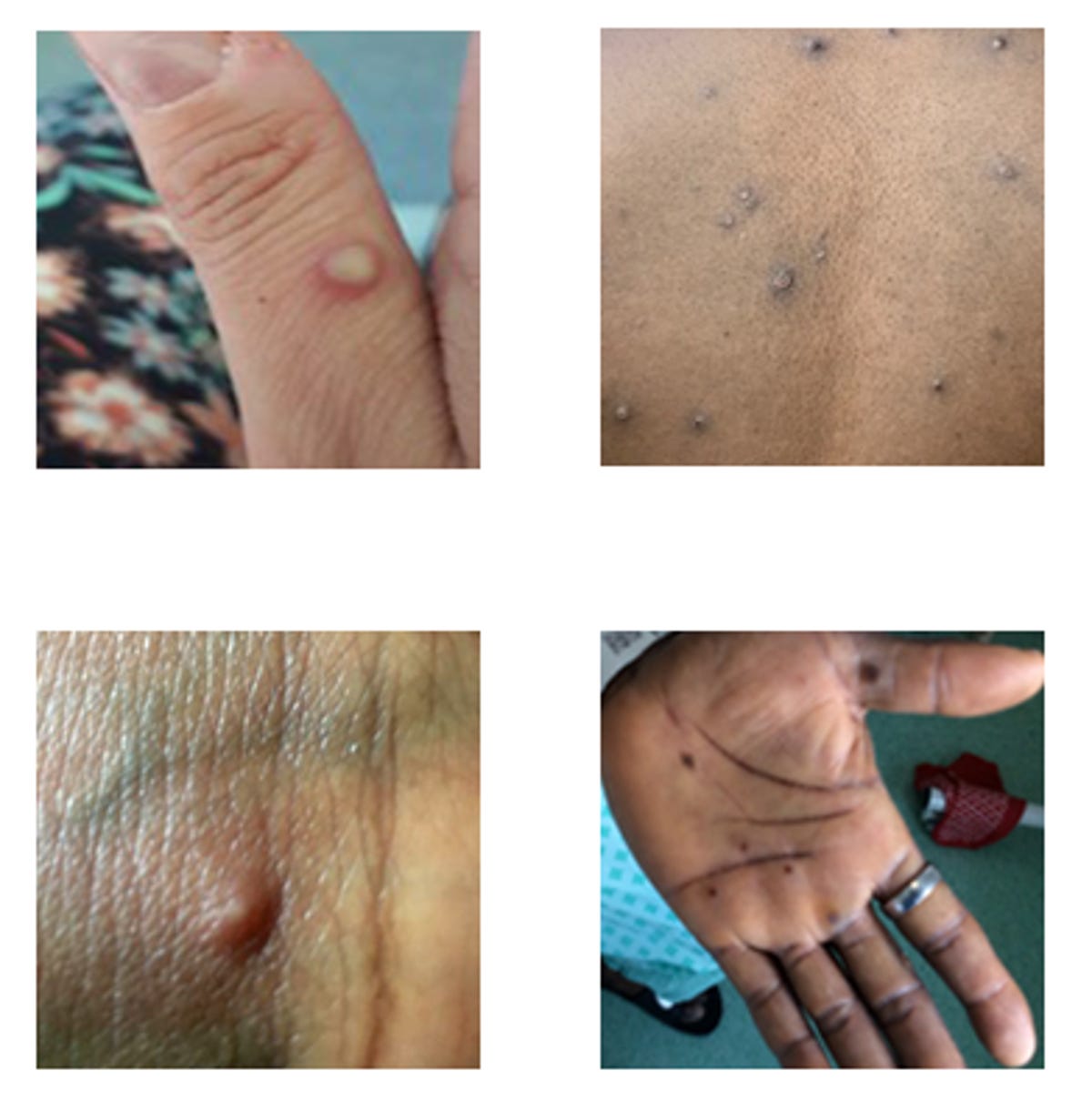 Four antithetic  photos of monkeypox blemishes and rashes