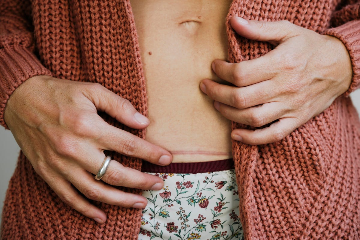 A person showing a C-section scar on his abdomen