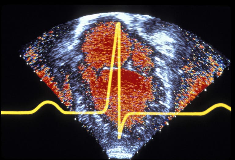 ABSTRACT OF HEART ACTIVITY AS SHOWN BY ELECTROCARDIOGRAM & ECHOCARDIOGRAM. (DOPPLER)