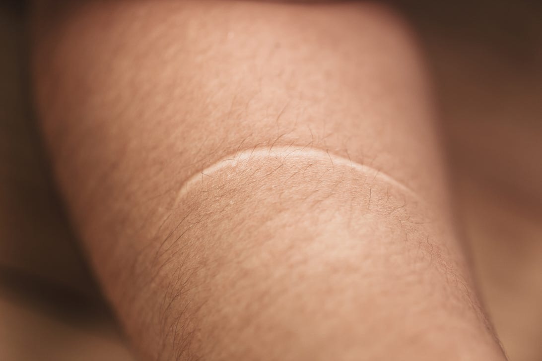 A scar on a person's arm