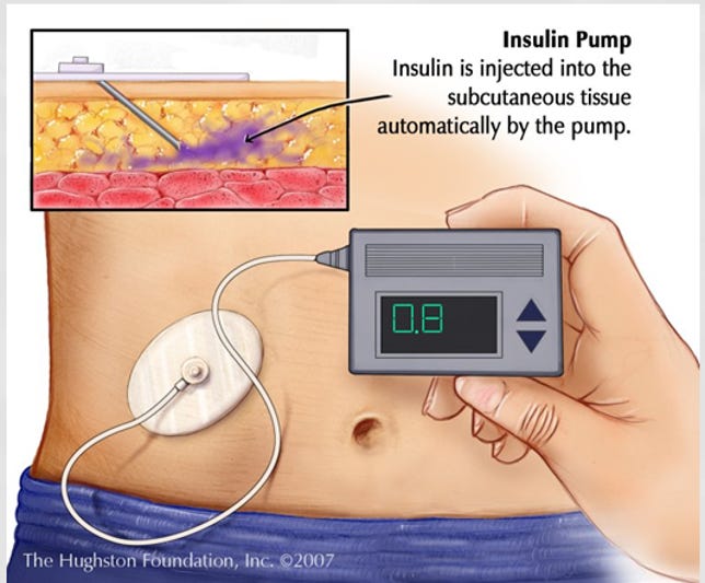Insulin pumps are attached to a patient's body and release carefully calculated amounts of medicine.