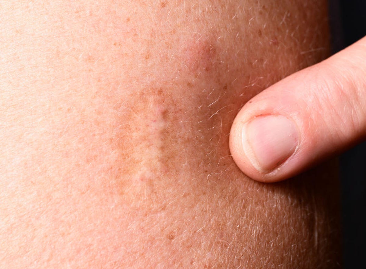 A smallpox vaccine scar