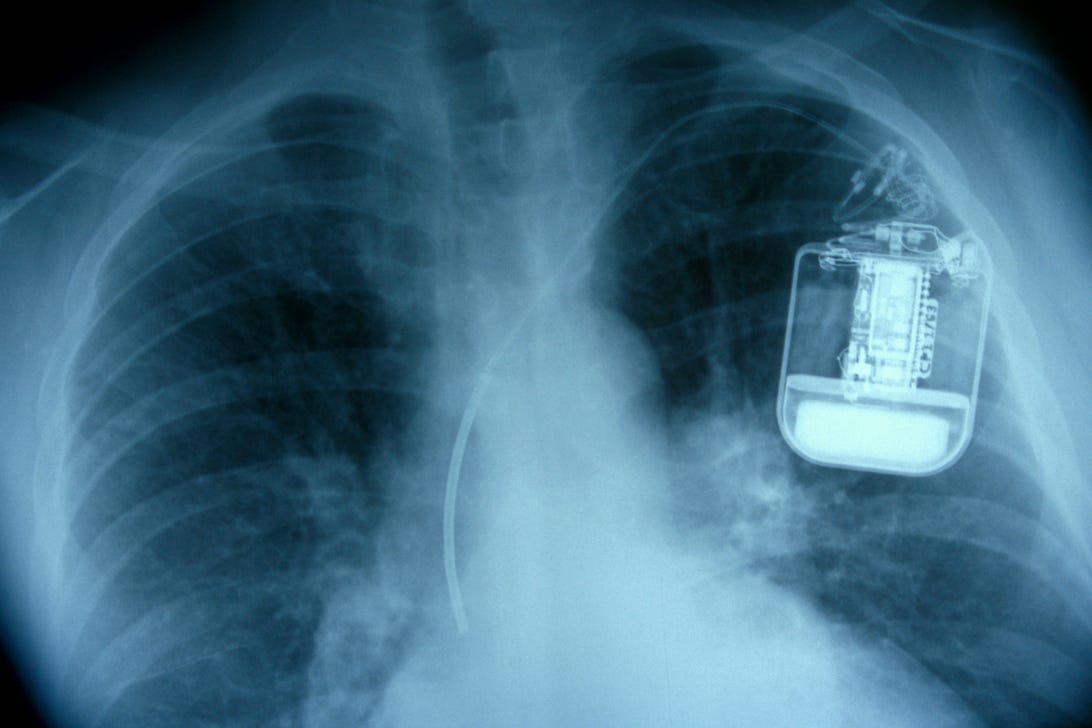 Abbott recalls 350,000 implantable defibrillators to protect against hacks