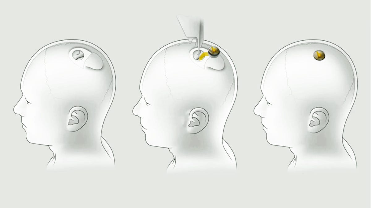 Sketch of three heads in white and gray showing how a Neurlink device would be inserted into a hole at the top of the skull..